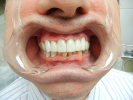 after porcelain crowns glendora ca dentist Anna Lee DDS
